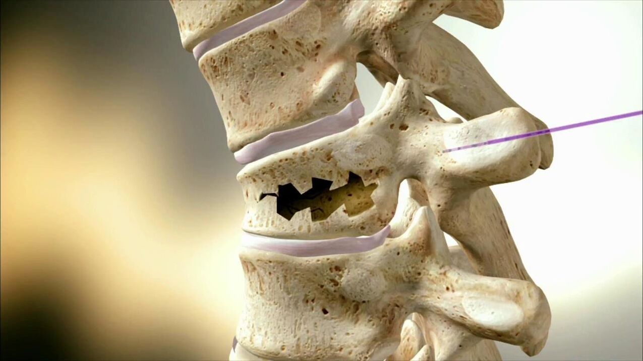 Damaged vertebra disk