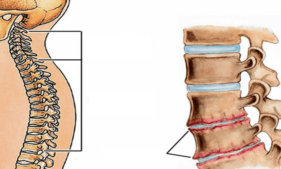 What does osteochondrose spine looks like