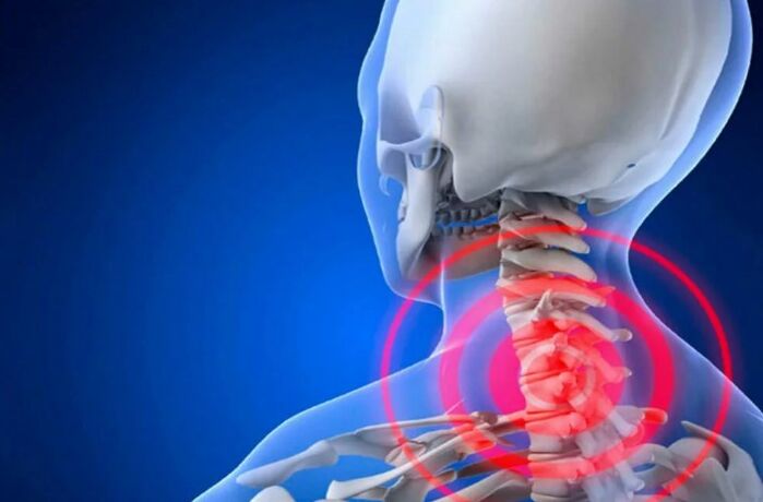 Osteochondrosis Bay of spine