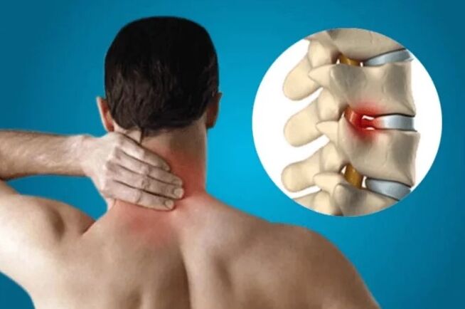 Osteochondrosis of spine