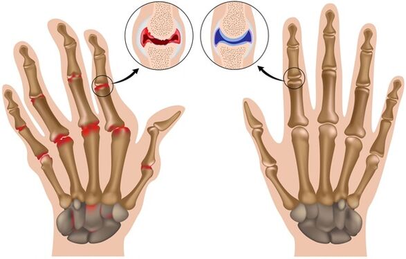 deformation of the fingers due to arthrosis