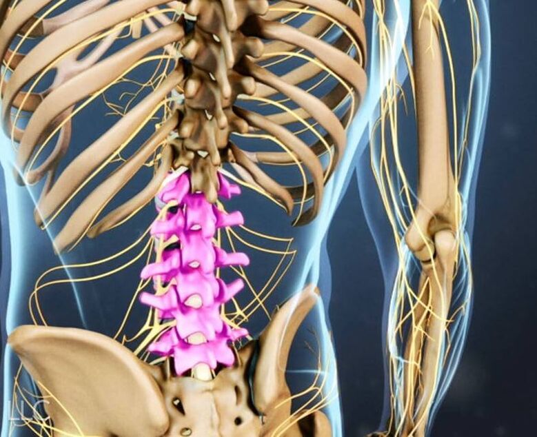 Osteochondrosis of the lumbar spine